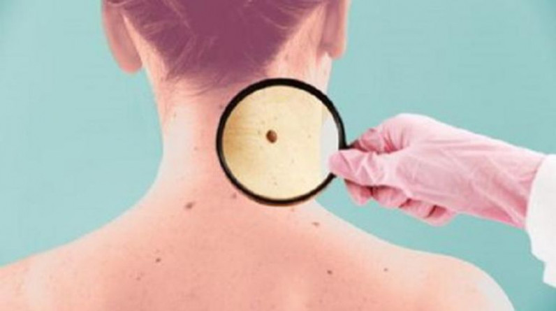 مسار يمنع تحول الشامات إلى أكثر أنواع سرطان الجلد فتكا