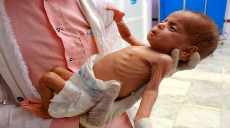الصحة العالمية: 27 طفلا توفوا في قطاع غزة سبب نقص الغذاء