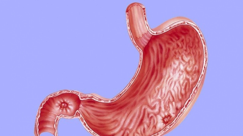 طبيب أمراض كبد يثير الجدل حول «جرثومة المعدة»: دي أورام متأخرة